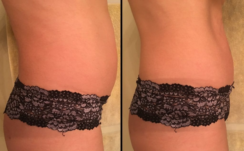 Body Contouring Rockville MD