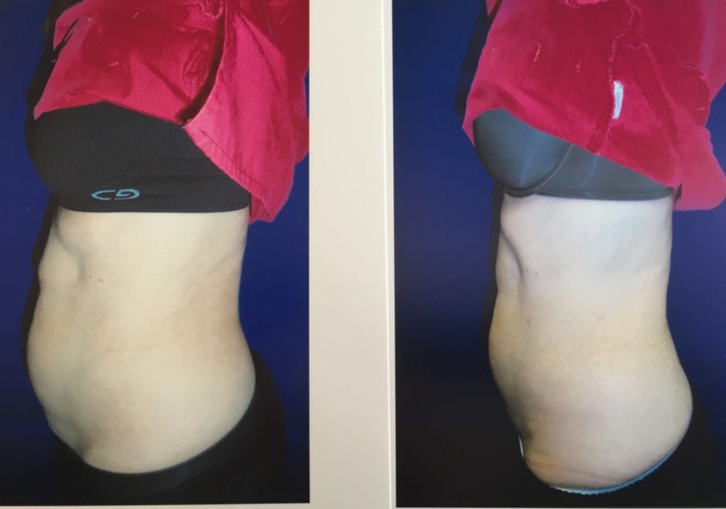 Body Contouring Silver Spring MD