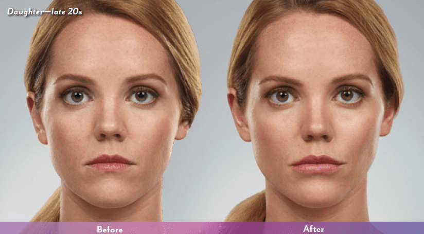 Juvederm W Med Spa