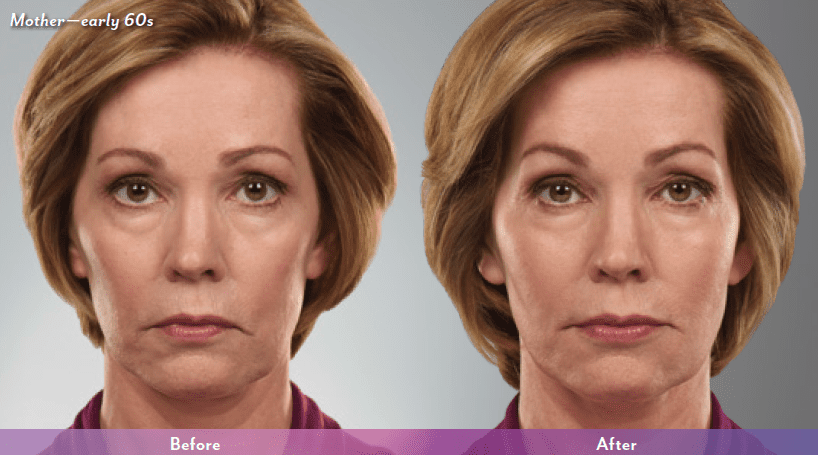 Juvederm