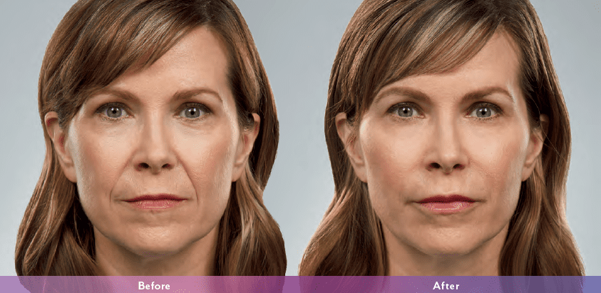 Juvederm Silver Spring Maryland