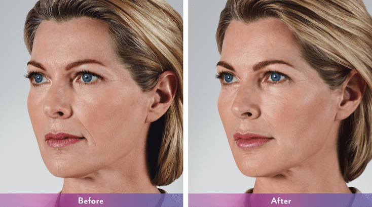 Juvederm Silver Spring MD