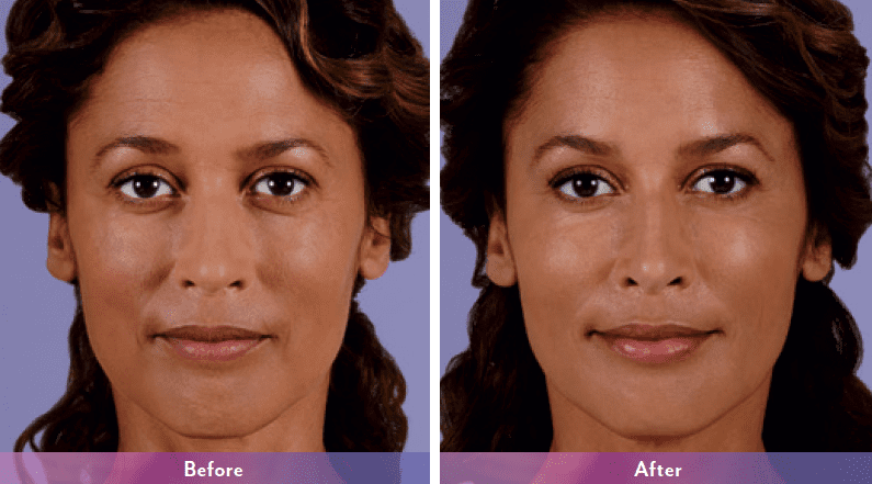 Juvederm Silver Spring