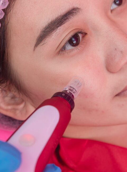 microneedling for acne scars in Silver Spring