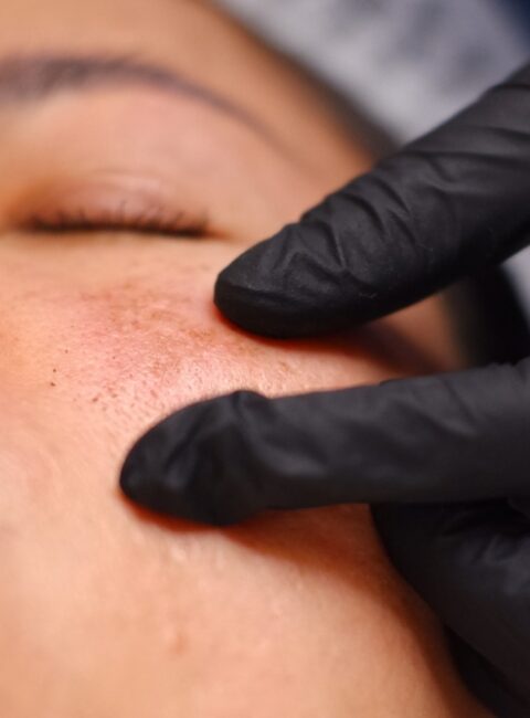 woman in need of complexion correction in Silver Spring